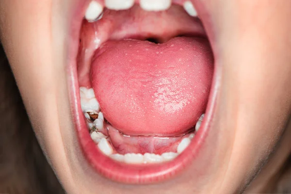 Молода дівчина кричить від зубного болю. Стоматологічні проблеми у дітей. Ранній карієс і зруйновані зуби. Концепція догляду за ротовою порожниною . — стокове фото