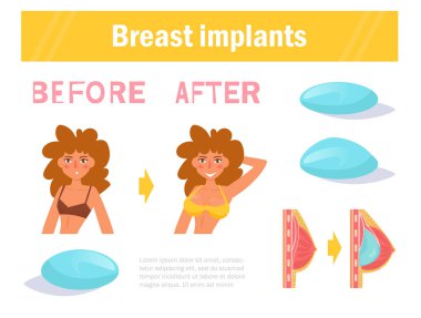 Önce ve sonra. Göğüs Cerrahisi. Vektör implantları. Çizgi film. Beyaz arka plan üzerinde izole sanat.