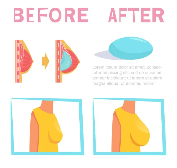 Antes y después. Cirugía de senos. Implantes Vector. Dibujos animados. Arte aislado sobre fondo blanco . — Vector de stock