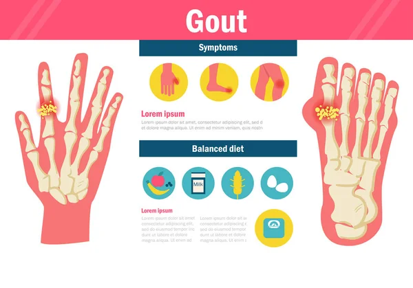 Gout Vector. Cartoon. Isolated art on white background. — Stock Vector