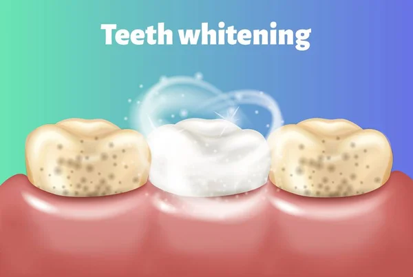 Идея отбеливания зубов. Грязный зуб и другие чистые и белые . — стоковый вектор