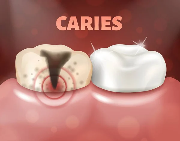 Diente con caries y diente sano. 3d ilustración realista de la enfermedad dental. Caries profunda en un diente enfermo — Vector de stock