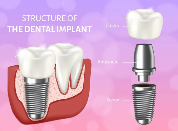 Векторная иллюстрация структуры зубного имплантата. Концепция проектирования процесса имплантации зубов . — стоковый вектор