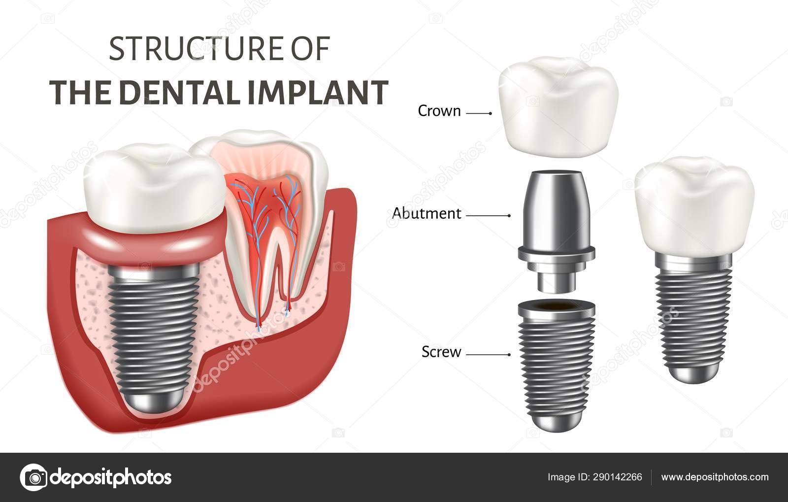 Educational poster showing a structure of the dental implant. Vector  illustration isolated on the white background. Stock Vector Image by  ©Woters #290142266
