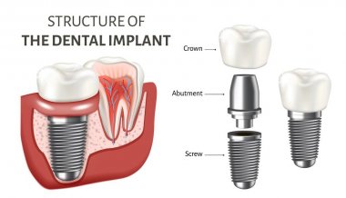 Diş implantının yapısını gösteren eğitim posteri. Beyaz arka planda yalıtılmış vektör çizimi.
