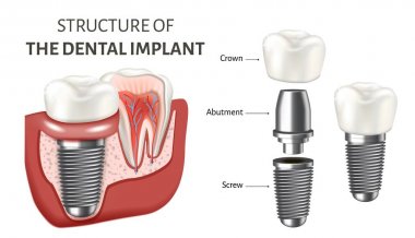 Educational poster showing a structure of the dental implant. Vector illustration isolated on the white background. clipart