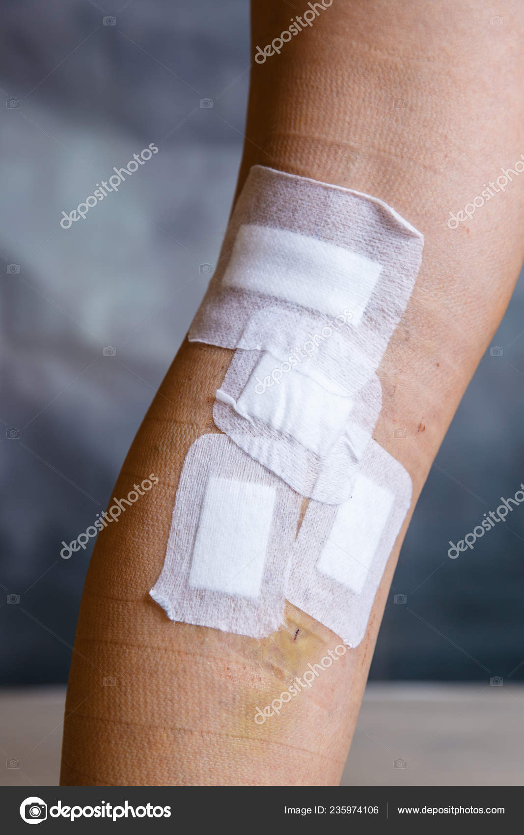 bandage salina i varicoza