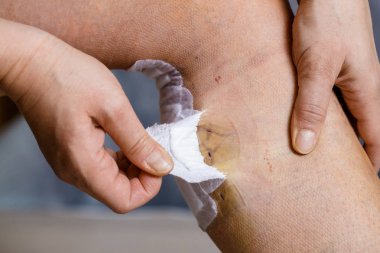 Bandaj kaldırma ve görünür yaralar ile varis cerrahisi sonrası bacağı teftiş kadın. Küratif tedavisi, estetik yordamlar, tromboz korunma ve Kıdemli Sağlık kavramı.