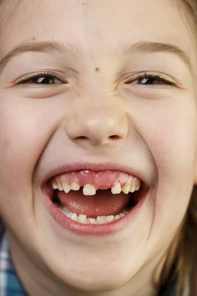 Menina Fazendo Rostos Sorrindo Mostrando Seus Dentes Leite Soltos Ausentes — Fotografia de Stock