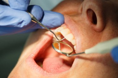 Onun ön dişler diş ve diş dişçi ofisinde interdental bir sonda ile muayene etleri diş hasta. Diş Bakımı, ağız hijyeni, önleme ve diş sorunları kavramı.