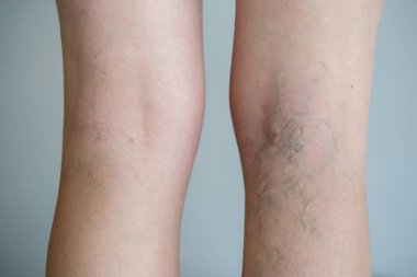 Painful varicose veins (spider veins, varices) on a severely affected leg. Ageing, old age disease, aesthetic problem concept. clipart