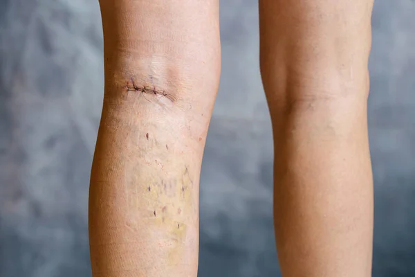 Kadının Bacakları Görünür Cerrahi Dikişler Dikiş Bir Bacak Yarası Ile — Stok fotoğraf