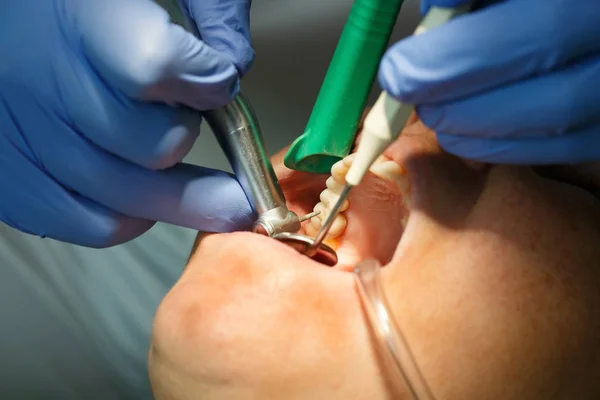 Οδοντιατρικός ασθενής πάρει την κοιλότητα γομφίο διάτρητοι — Φωτογραφία Αρχείου