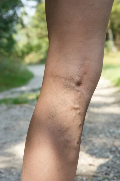 Mulher com dolorosas varizes inchadas descansando em uma caminhada pela natureza . — Fotografia de Stock