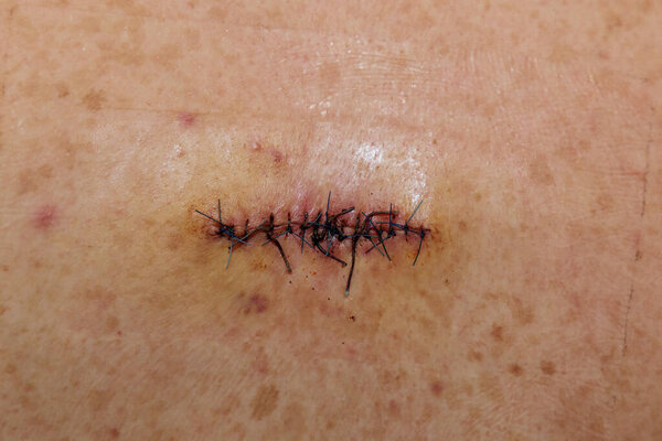 Двойной шрам от абсцессной операции на спине