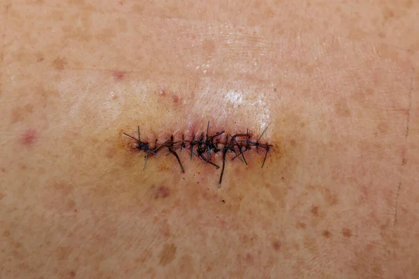 Dupla Cicatriz Suturada Cirurgia Abscesso Umas Costas Fotografia De Stock