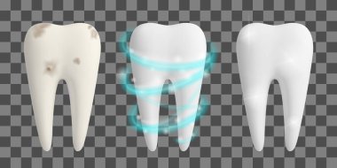 Temiz ve kirli diş. Diş beyazlatma işlemi. Diş sağlığı tasarımı konsepti. Gerçekçi vektör illüstrasyonu.