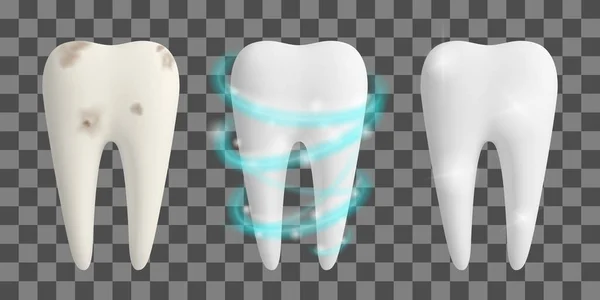 Schone en vieze tand. Teeth Whitening proces. Tandheelkundige gezondheid ontwerp concept. Realistische vector illustratie. — Stockvector