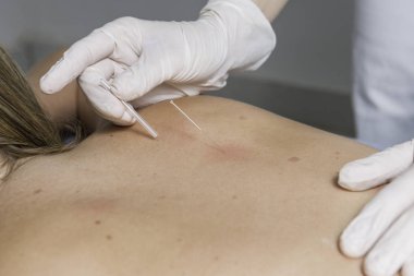Doktor akupunkturda sarışın kızın vücuduna iğne saplar..