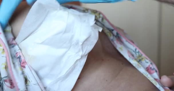 Vendaje Paciente Drenada Después Cirugía Mama — Vídeos de Stock