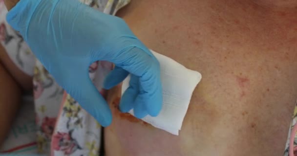 Verband Der Entleerten Patientin Nach Brustoperation — Stockvideo