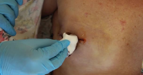 Bandaging após cirurgia mamária 6 — Vídeo de Stock