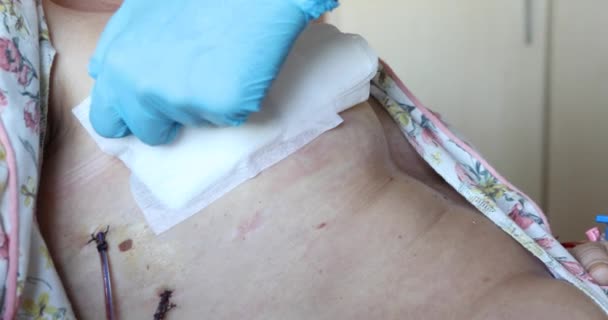 Bandaging Paciente Drenada Após Cirurgia Mamária — Vídeo de Stock