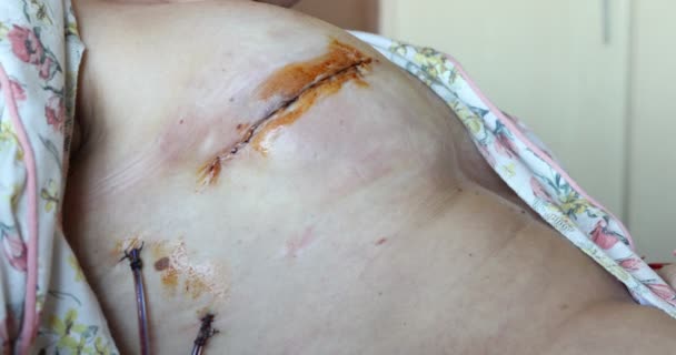 Bandaging Paciente Drenada Após Cirurgia Mamária — Vídeo de Stock