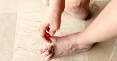 Hallux valgus kadın bacak 4