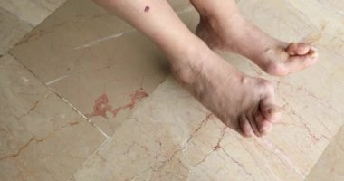 Hallux valgus kadın bacak 6