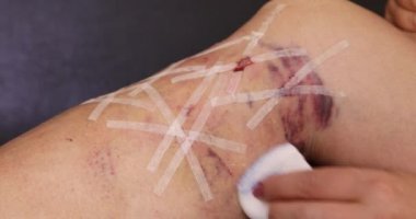 9 nolu varisli damar ameliyatından sonra bandajını çıkaran kadın bacağını çıkarıyor.