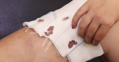 7 nolu varisli damar ameliyatından sonra bandajını çıkaran kadın bacağını çıkarıyor.