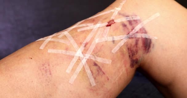 Женская Нога Пациента После Операции Варикозном Расширении Вен — стоковое видео