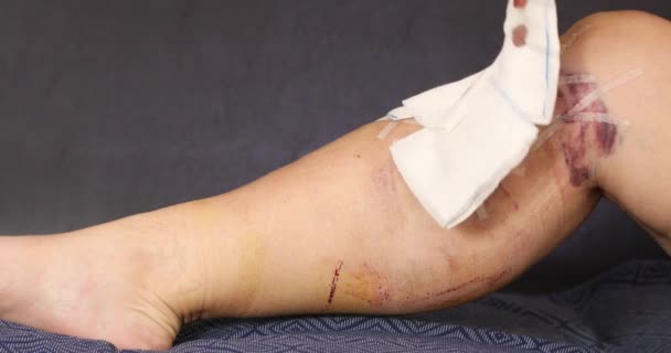 医療静脈瘤手術後の女性患者脚 — ストック動画