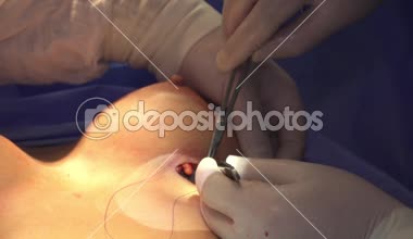 Cerrahi meme büyütme. Bir meme implantı montajı. Ameliyathane cerrahisinde meme büyütme cerrahisi implant aletleri. 