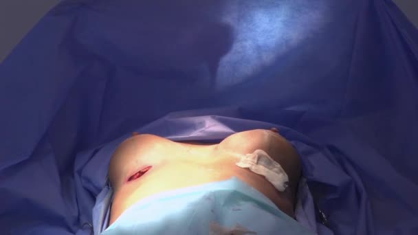 手术隆胸 乳房植入物的安装 手术室外科医生工具植入物中的隆胸手术 — 图库视频影像
