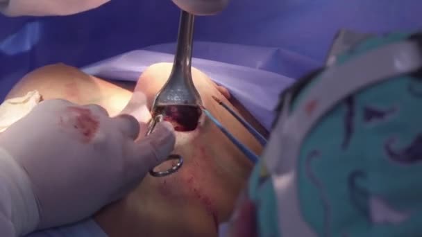 Хирургическое Увеличение Груди Установка Грудного Импланта Операция Увеличению Груди Операционной — стоковое видео