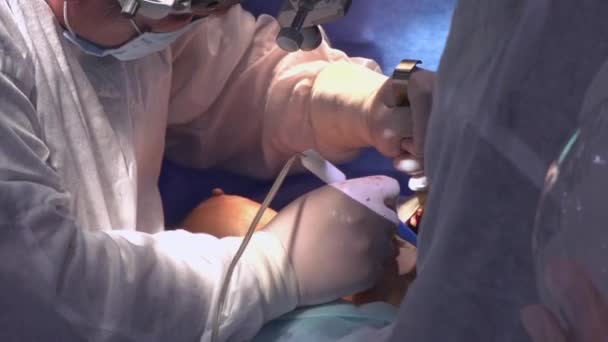 Operative Brustvergrößerung Einbau Eines Brustimplantats Brustvergrößerungschirurgie Operationssaal Chirurg Werkzeuge Implantat — Stockvideo
