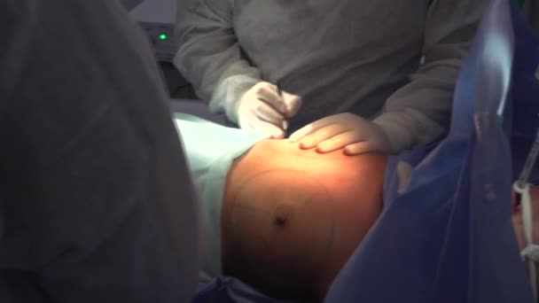 外科的乳房拡張 乳房インプラントのインストール 手術室外科医ツールインプラントにおける乳房拡張手術 — ストック動画