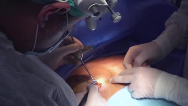 Chirurgický Zesilující Prsa Instalace Náprsní Implantátu Transplantace Prsu Operačním Sále — Stock video