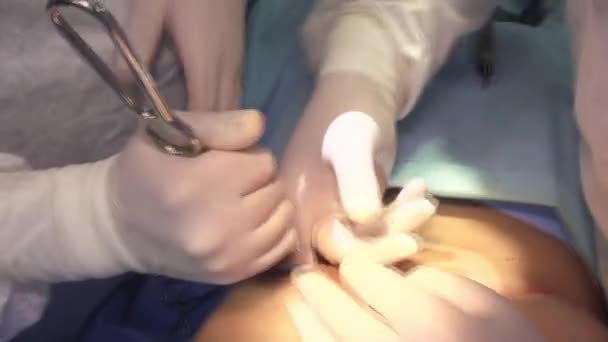 Aumento Quirúrgico Senos Instalación Implante Mamario Cirugía Aumento Senos Quirófano — Vídeos de Stock