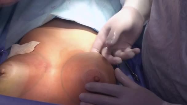 Chirurgische Borstvergroting Installatie Van Een Borstimplantaat Borstvergroting Chirurgie Operatiekamer Chirurg — Stockvideo