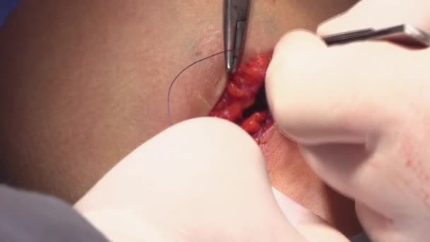 Augmentation Mammaire Chirurgicale Installation Implant Mammaire Chirurgie Augmentation Mammaire Dans — Video