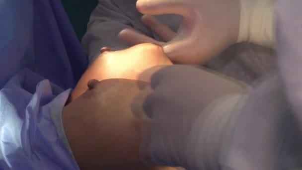 Chirurgický Zesilující Prsa Instalace Náprsní Implantátu Transplantace Prsu Operačním Sále — Stock video