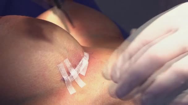 手术隆胸 乳房植入物的安装 手术室外科医生工具植入物中的隆胸手术 — 图库视频影像
