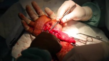 Bileği dikmek için ameliyat. Beyin cerrahları ve travmatologlardan oluşan ekip eli onarıyor. Bilekte sinir ve tendon dikmek için ameliyat.