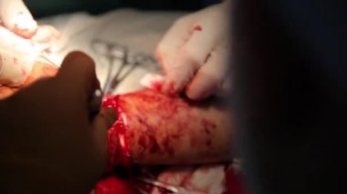 Bileği dikmek için ameliyat. Beyin cerrahları ve travmatologlardan oluşan ekip eli onarıyor. Bilekte sinir ve tendon dikmek için ameliyat.