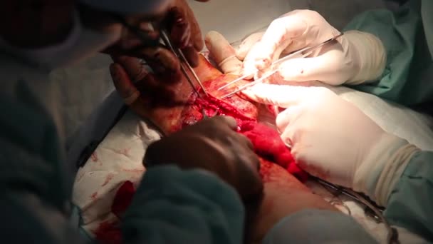 Chirurgie Pour Coudre Poignet Équipe Neurochirurgiens Traumatologues Restaure Main Chirurgie — Video