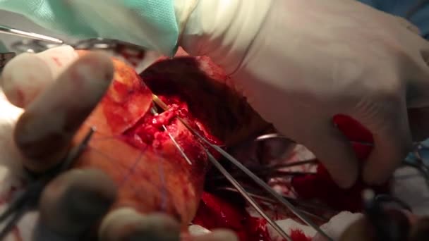 缝合手腕的手术 神经外科医生和创伤学家团队恢复了手部 手术缝合手腕上的神经和肌腱 — 图库视频影像