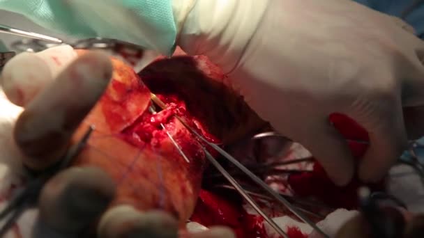 Cirurgia Para Coser Pulso Equipe Neurocirurgiões Traumatologistas Restaura Mão Cirurgia — Vídeo de Stock